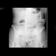 Small bowel ileus, right sided nephrolithiasis: X-ray - Plain radiograph